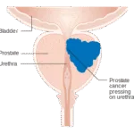 Symptoms to Watch For Prostate Cancer Image credit Wekipedia