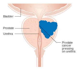 Joe Biden’s Prostate Cancer Diagnosis Sparks Urgent Men’s Health Conversation